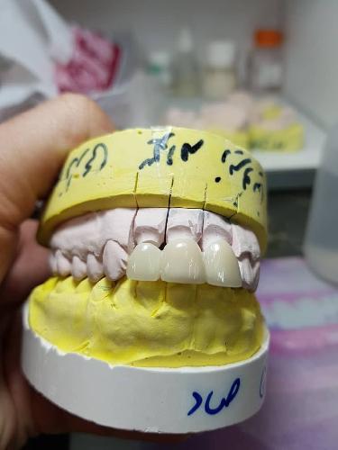 دندانسازی در قزوین
