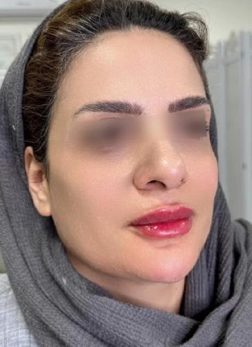 زیبایی و لیزرموهای زائد در تبریز