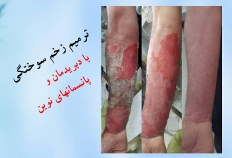 ترمیم زخم  در تبریز