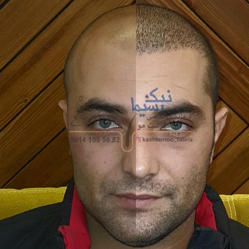 کاشت مو ، لیزر ، جراحی های پوست در تبریز