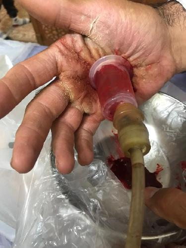 حجامت در شیراز در شیراز حجامت - طب سنتی در شیراز