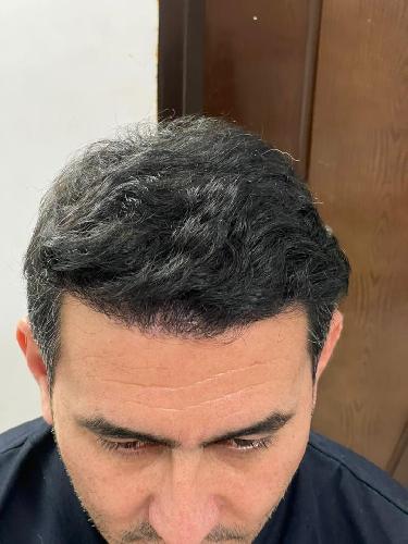 کاشت موی تخصصی ایمانی در تبریز