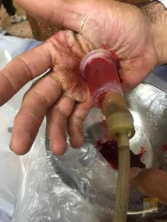 نمونه کار حجامت در شیراز در شیراز - 8