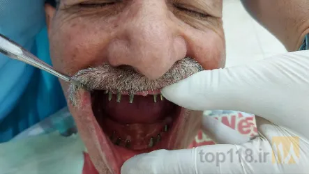 نمونه کار دندانپزشکی دکترمحمدرضا پرورش  در تبریز - 8