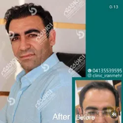 نمونه کار درمانگاه کاشت موی ایران مهر  در تبریز - 9