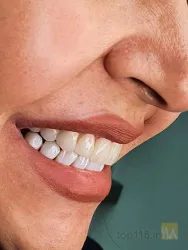 نمونه کار دندانپزشکی دکتر سعید حاجی پور  در تبریز - 9