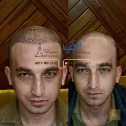 نمونه کار تیم کاشت موی رحیمی در تبریز - 9