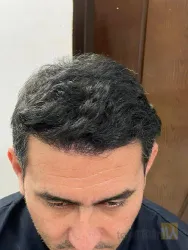 نمونه کار  کاشت مو ایمانی در تبریز - 8
