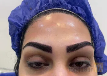 نمونه کار کاشت مو تخصصی در تبریز - 9