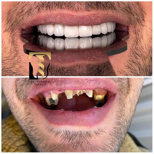 دندانپزشکی دکتر سید ابراهیم تقوی در تبریز زیبایی ایمپلنت در تبریز