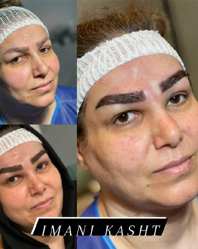 کاشت موی تخصصی ایمانی در تبریز