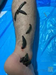 نمونه کار حجامت در شیراز در شیراز - 1