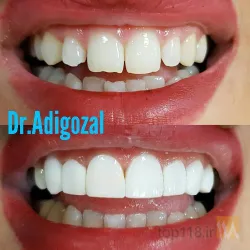 نمونه کار دندانپزشکی دکتر آدی گوزل در تبریز - 1
