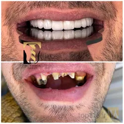 نمونه کار دندانپزشکی  دکتر سید  ابراهیم تقوی در تبریز - 1