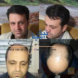 نمونه کار تیم کاشت موی رحیمی در تبریز - 1