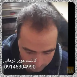 نمونه کار بهترین کاشت مو در تبریز  کاشت موی فرمانی در تبریز - 1