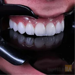 نمونه کار کلینیک  تخصصی دندانپزشکی مروارید در تبریز - 1