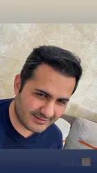 نمونه کار کاشت مو تخصصی در تبریز - 1