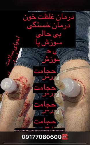 حجامت در شیراز در شیراز حجامت - طب سنتی در شیراز