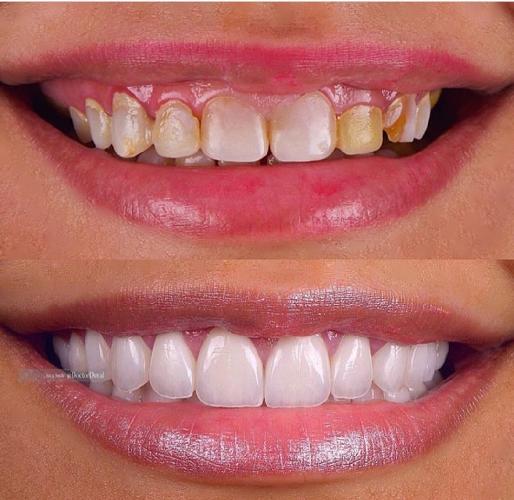 Tüm çənə implant-estetika در تبریز İmplant və gülüş uygulaması در تبریز