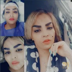 نمونه کار بهترین کاشت ابرو در تبریز کاشت ابروی باقری در تبریز - 2
