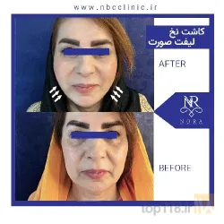 نمونه کار بهترین لیفت با نخ در تبریز - 2