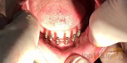 نمونه کار دندانپزشکی دکترمحمدرضا پرورش  در تبریز - 2
