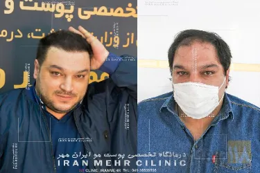 نمونه کار درمانگاه کاشت موی ایران مهر  در تبریز - 2