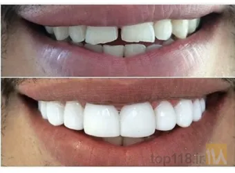 نمونه کار دندانپزشکی دکتر بابک میدانی در تبریز - 2