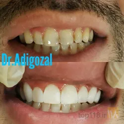 نمونه کار دندانپزشکی دکتر آدی گوزل در تبریز - 2