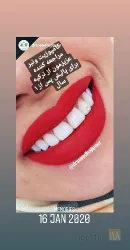 نمونه کار دندانپزشکی دکتر سعید حاجی پور  در تبریز - 2