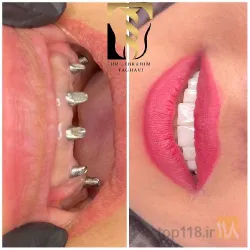 نمونه کار دندانپزشکی  دکتر سید  ابراهیم تقوی در تبریز - 2