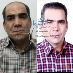 نمونه کار تیم کاشت موی رحیمی در تبریز - 2