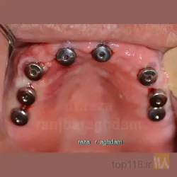 نمونه کار دکتر رضا رنجبر اقدم   ایمپلنت تمام فک- طرح لبخند متناسب با صورت- لمینیت-کامپوزیت در تبریز - 2