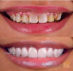 نمونه کار Tüm çənə implant-estetika در تبریز - 2