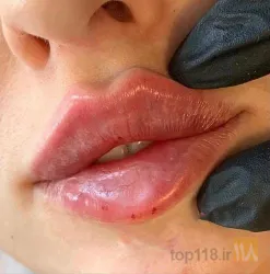 نمونه کار کلنیک زیبایی پوست و مو دکتر حقیقی در تبریز - 2