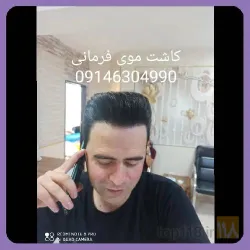 نمونه کار بهترین کاشت مو در تبریز  کاشت موی فرمانی در تبریز - 2