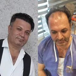نمونه کار  کاشت مو ایمانی در تبریز - 1