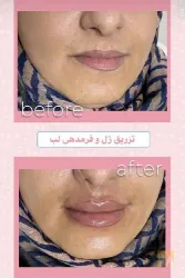 نمونه کار مرکز لیزر برفین در تبریز - 2