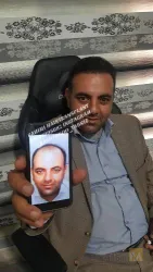 نمونه کار کلینیک تخصصی کاشت موی رحیمی در تبریز - 2