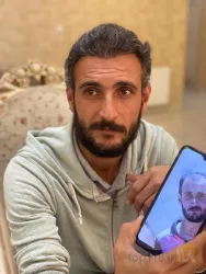 نمونه کار کاشت مو تخصصی در تبریز - 2