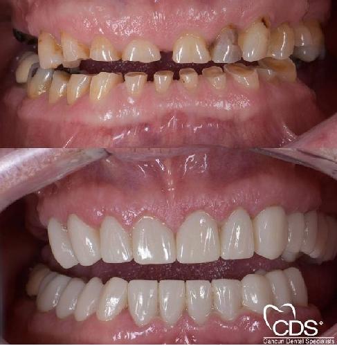 Tüm çənə implant-estetika در تبریز İmplant və gülüş uygulaması در تبریز