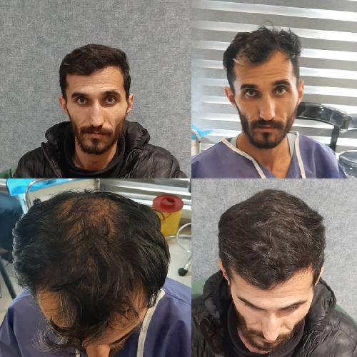 کاشت موی تخصصی ایمانی در تبریز