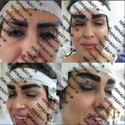 نمونه کار بهترین کاشت ابرو در تبریز کاشت ابروی باقری در تبریز - 3