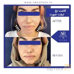 نمونه کار بهترین لیفت با نخ در تبریز - 3