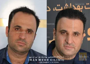 نمونه کار درمانگاه کاشت موی ایران مهر  در تبریز - 3