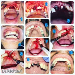 نمونه کار دندانپزشکی دکتر بابک میدانی در تبریز - 3