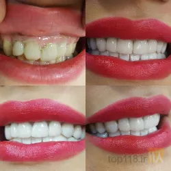 نمونه کار دندانپزشکی دکتر آدی گوزل در تبریز - 3