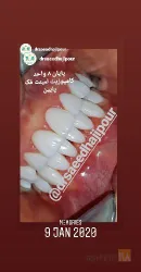 نمونه کار دندانپزشکی دکتر سعید حاجی پور  در تبریز - 3