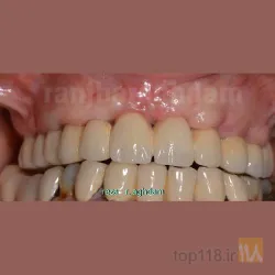 نمونه کار دکتر رضا رنجبر اقدم   ایمپلنت تمام فک- طرح لبخند متناسب با صورت- لمینیت-کامپوزیت در تبریز - 3